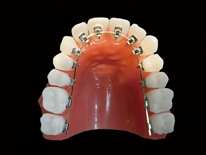 周囲に気づかれにくい矯正器具です