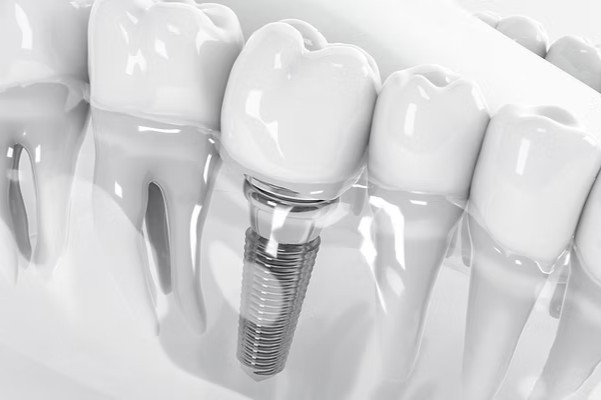 1歯からのインプラント治療に対応しており、治療期間の目安は3か月からです