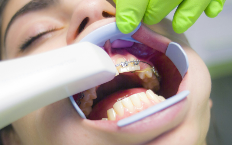 自然な輝きを引き出す歯の美白ケア