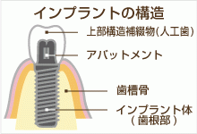 世界的に高いシェアを誇るスウェーデンのノーベルバイオケア社のインプラントを使用し、患者様に最適な治療を提供しています