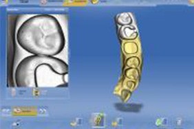 コンピューターの3D画面上で修復物を設計します