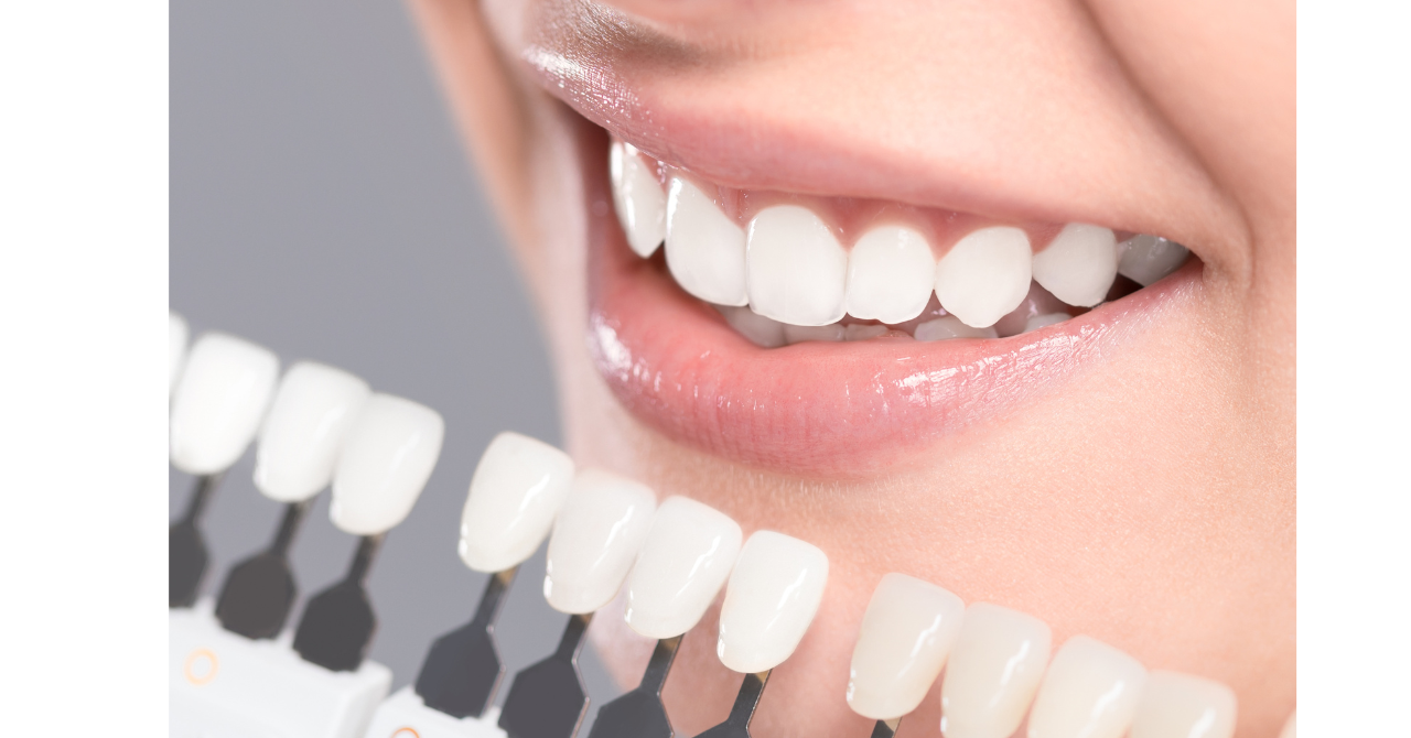 歯の美しさで笑顔に自信を