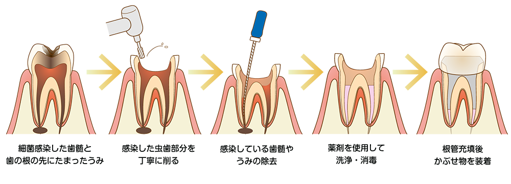 神経を守り歯を残す根管治療