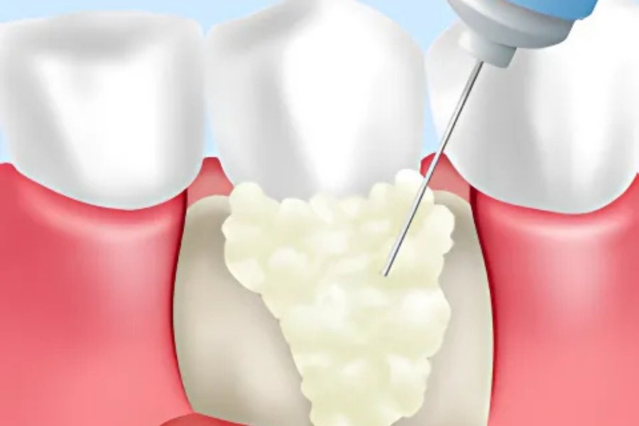 歯周組織を薬剤で再生します