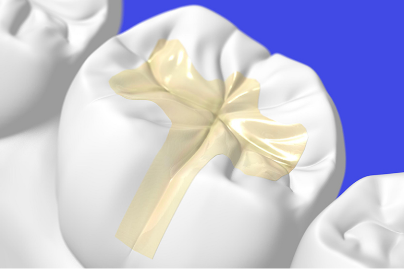 自分のペースで自宅でホワイトニング