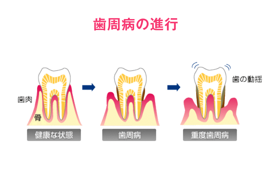 歯ぐきの健康が歯を守る鍵