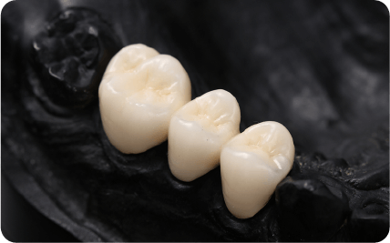 美しく健康な歯に近づけるためのオーダーメイド治療のオールセラミック写真画像です。