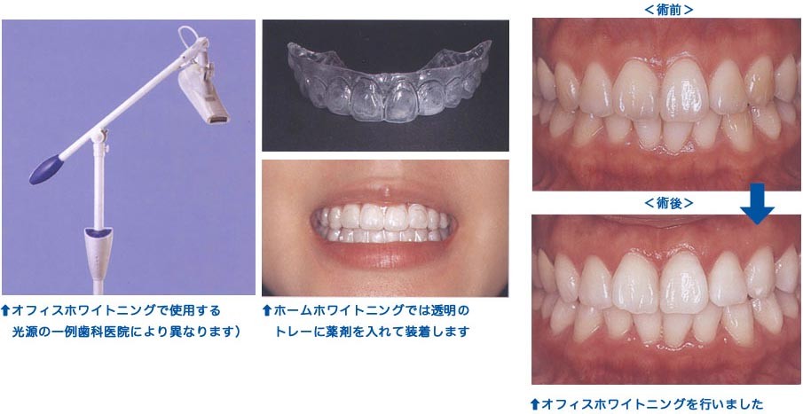 歯を白くする様々なアプローチ