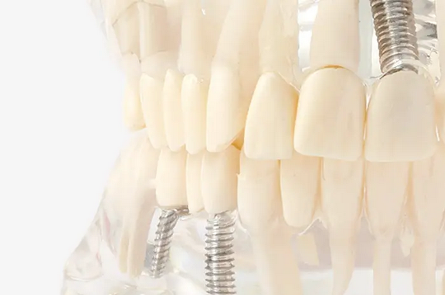 安全性と信頼性を最優先に考えたインプラント治療