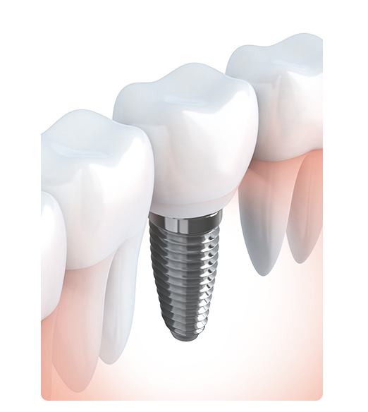 事前に適切な治療や処置を施すことで、インプラントが長持ちする環境を整えます
