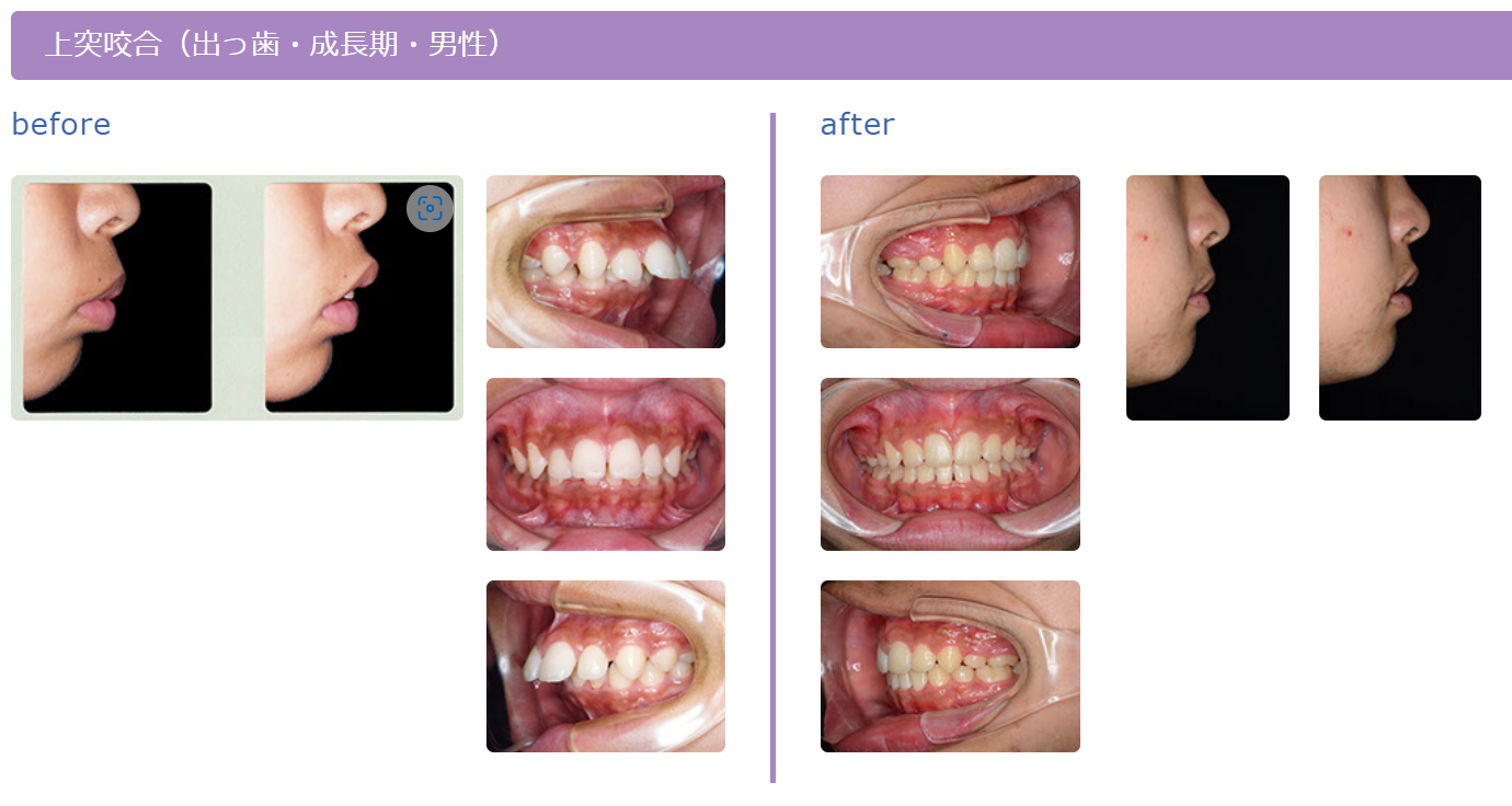 上突咬合（出っ歯・成長期・男性）の治療例です