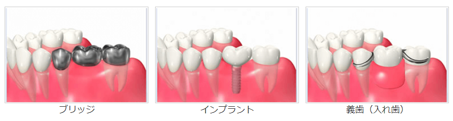 欠損補綴の種類