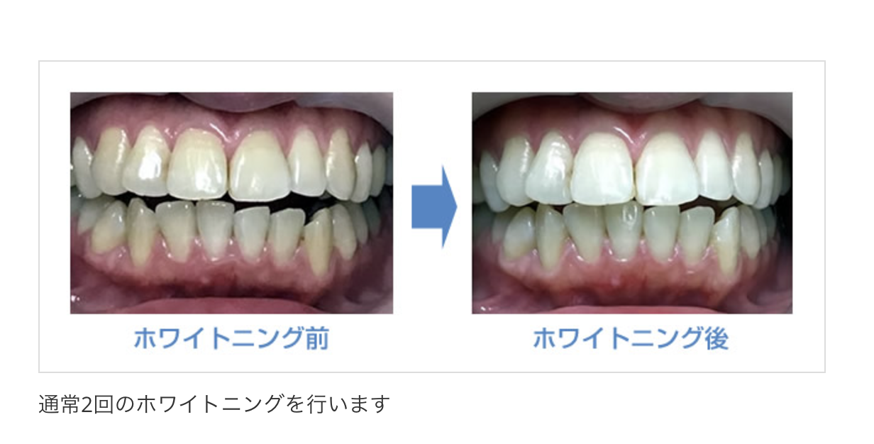 「KEN'Sホワイトニング」という快適性と効果を両立させたホワイトニングをご提供しています