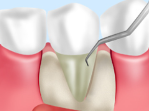 フラップ手術のイメージ