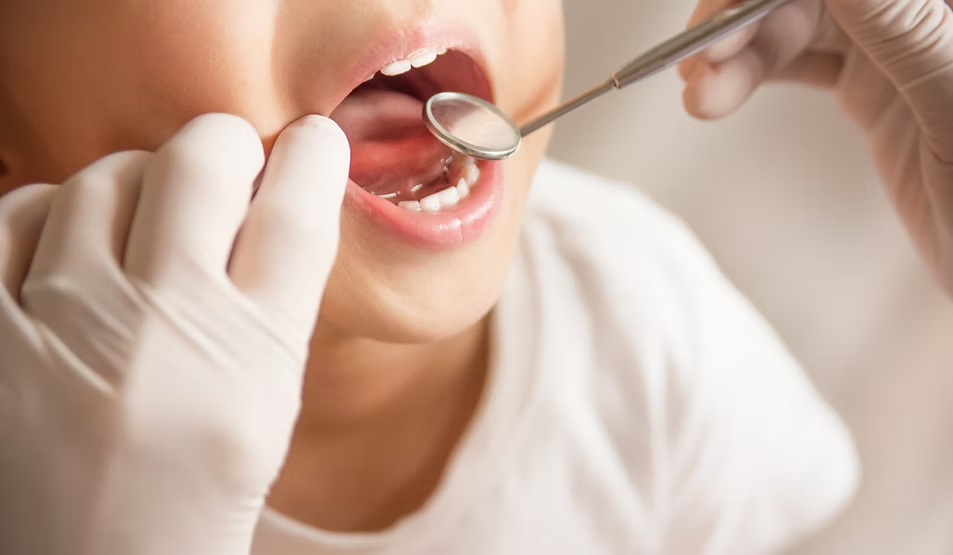 フッ素とシーラントで虫歯予防