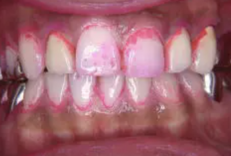 POICウォーター（ホームケア）で再発を防ぎます