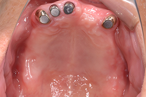 「これが入れ歯？」と驚くほどの安定感と自然な見た目