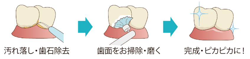 歯のクリーニングなどでトラブルを防ぎます