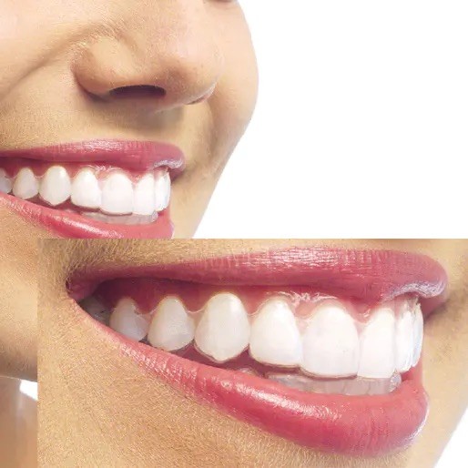 気付かれない矯正治療