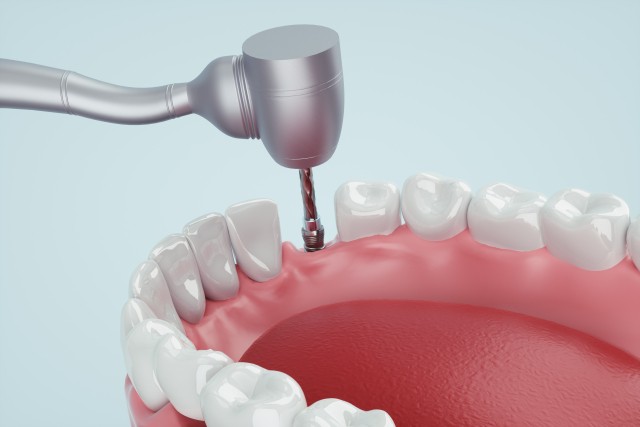 むし歯や外傷などによって失われた歯の機能や見た目を回復するための大切な治療です。※写真はイメージです。