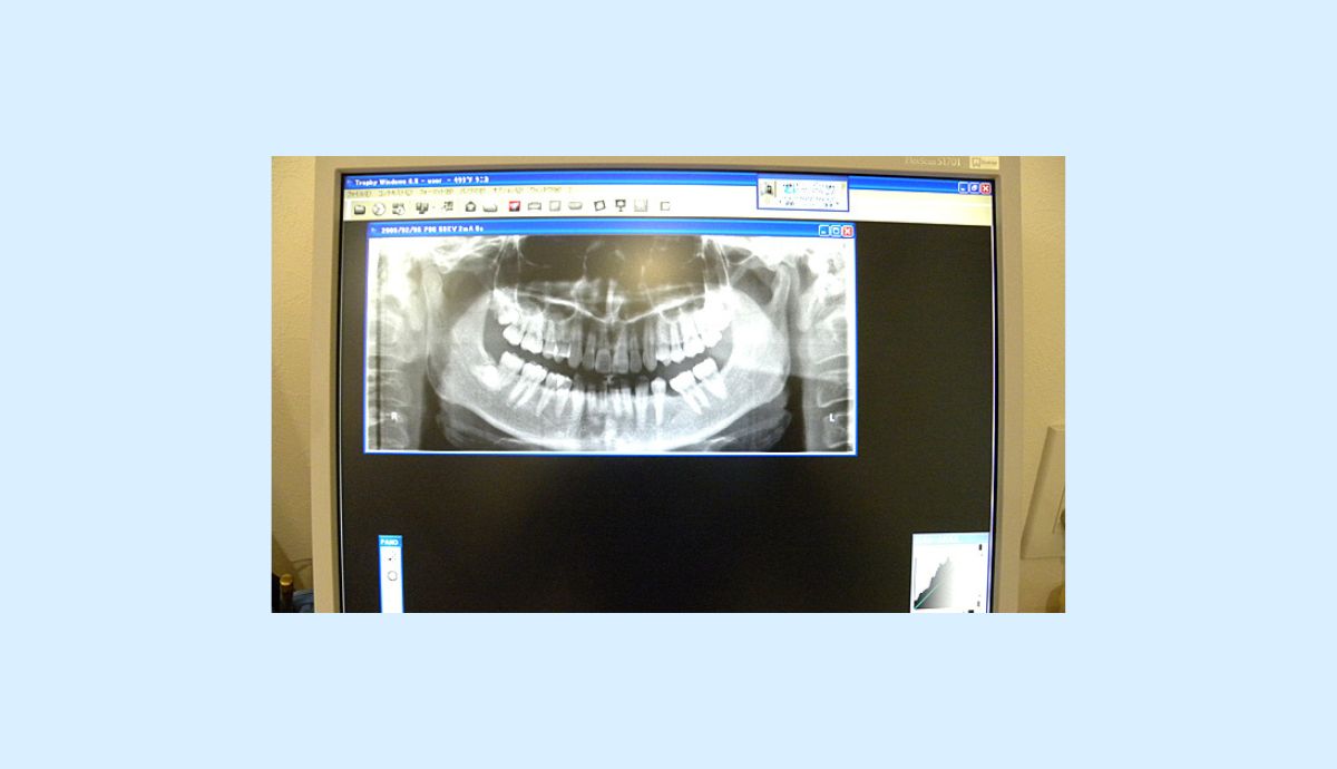 デジタルレントゲンを導入しています