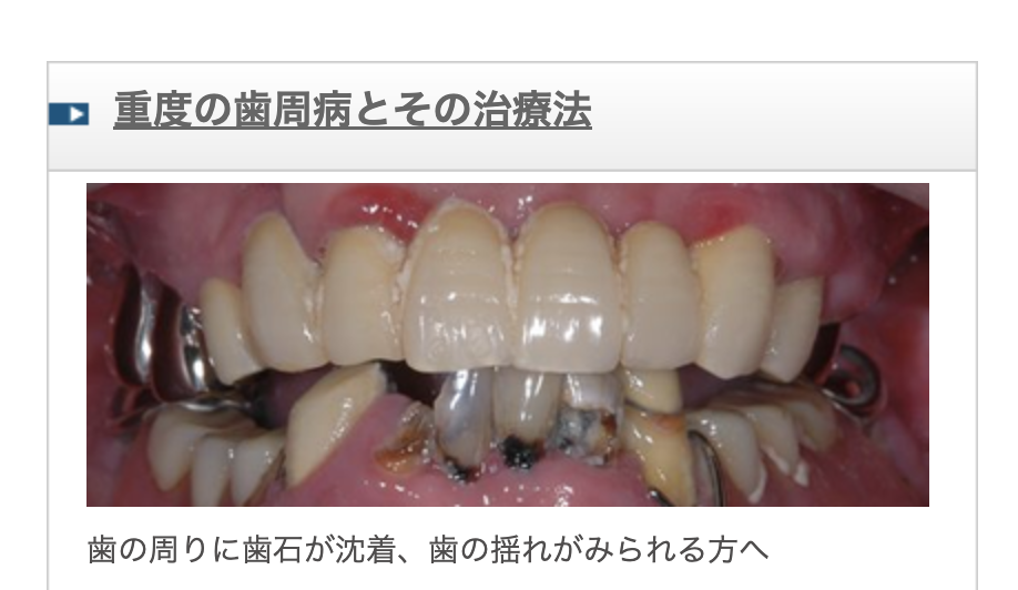重度歯周病は、歯ぐきの腫れや赤みが進行し、歯周ポケットが深くなり5mm以上になる状態です