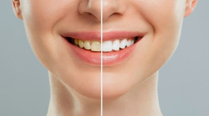 ホワイトニングは歯を漂白するだけではありません