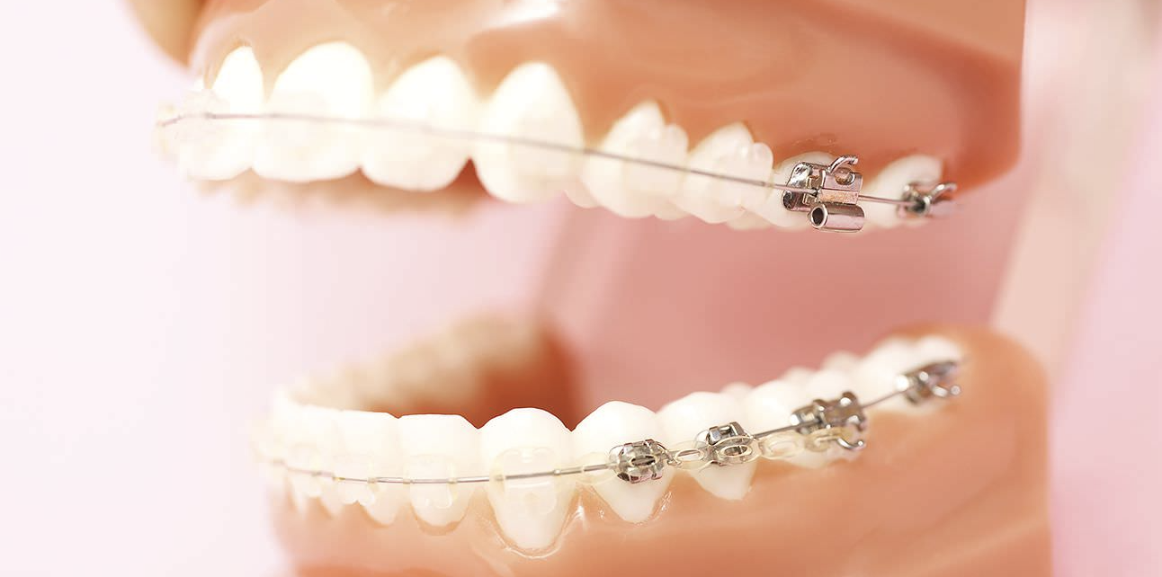 専用の装置を用いて歯を正しい位置へと導き、健康な口腔環境を維持しやすい状態へ整えます