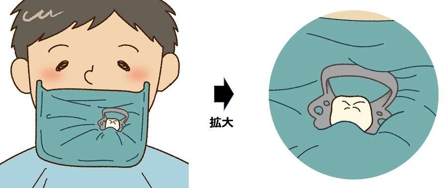 根管治療の成功確率を高めるため、ラバーダムを必ず使用しております