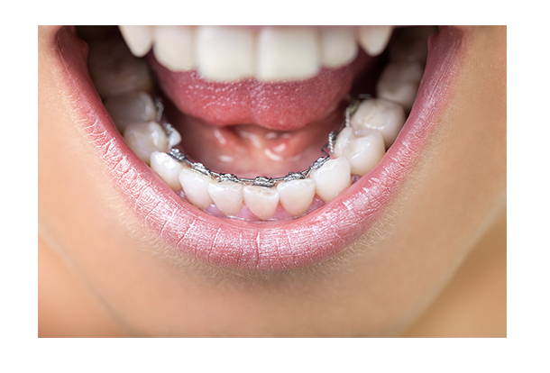 大人の矯正治療において顎関節症の治療と咬み合わせの改善にも取り組んでいます