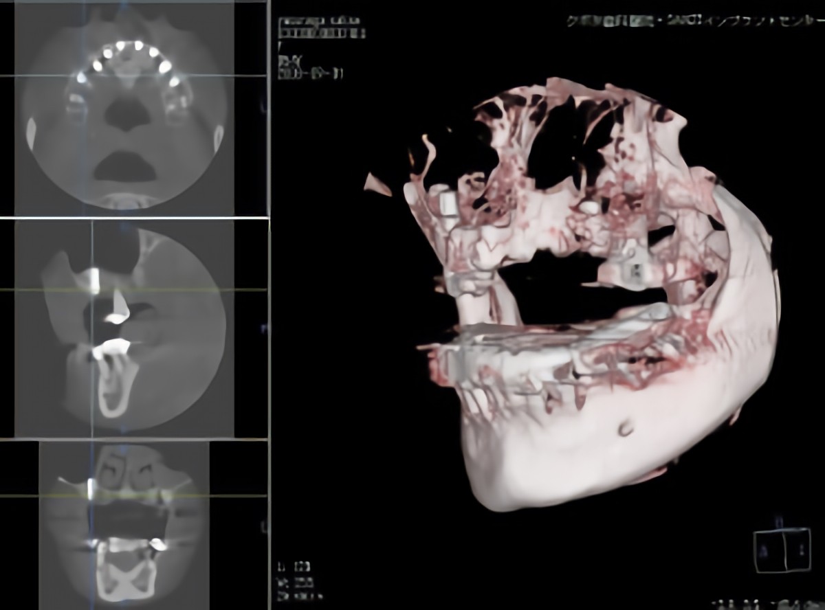 コーンビームCTの撮影画像