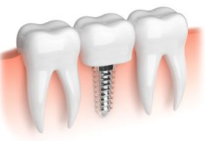 自分の歯と同じようにしっかりと機能し、長期間にわたって安定した状態を維持できるため、多くの患者様にとって理想的な治療方法となっています。
