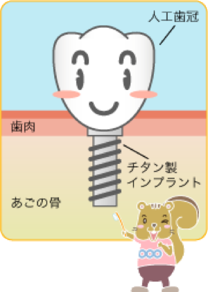 リスクを抑えたインプラント治療のために、事前の診断が重要です